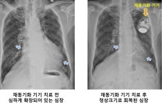 삼성서울병원, 심장재동기화 치료 300예 달성