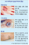 알고 있나요? 피부에도 암이 생긴다는 사실!