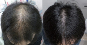 [생활건강] ‘가을철 특명’ 탈모를 막아라!