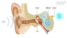 분당서울대병원 이비인후과 청각재활센터 인공와우 이식 수술 1,000례 달성