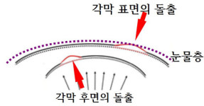 진주 이성수 안과 각막형태교정술 보건신기술 인증