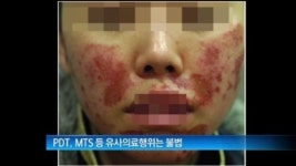 [굿모닝!]예뻐지려고 피부관리실 갔다가…불법 무자격자 시술 조심