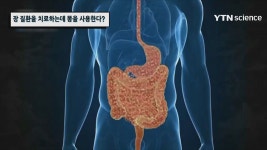 장 질환을 치료하는데 똥을 사용한다?