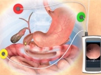 고속 영상전송 캡슐 내시경 개발