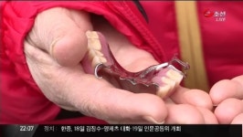 임플란트 피해 급증…공정위, 표준약관 제정