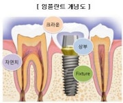 노인 임플란트 본인부담 축소 후 임플란트업체들 함박웃음