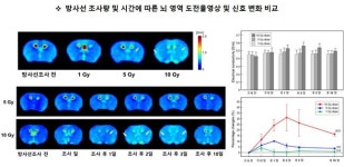 방사선 치료 후 조직변화, MRI 영상으로 진단 가능해진다