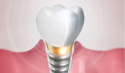 치과 임플란트 경쟁력 높인다