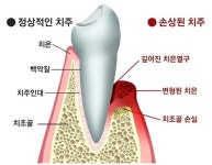 치주질환 방치하면 잇몸뼈 부족해져 임플란트 어려워져