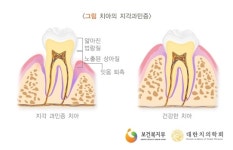 충치 아닌데도 이가 시린 ‘상아질 지각과민증’