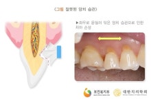 충치 아닌데도 이가 시린 ‘상아질 지각과민증’