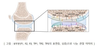 대전을지대병원, 무릎 반월연골판 동종이식술 연골보호 효과 최초 입증 