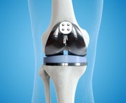 통증으로 제대로 걷지 못하는 부모님…인공관절로 새로운 삶 시작