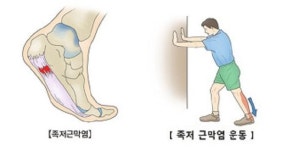 족저근막염, 최근 5년간 2배 증가
