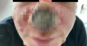 코가 아예 까맣게 썩어버린 남자… 원숭이두창, 이렇게 무섭습니다 (사진)