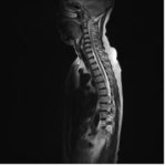 노교수의 난치병 한약치료 이야기 ‘목 디스크’