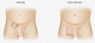 소아탈장 (1) 소아탈장이란?