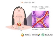 갑상선암 종류, 예후가 가장 나쁜 갑상선암은?