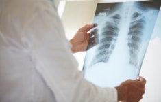 암세포의 증식과 재발 막는 유방암 ‘방사선 치료’