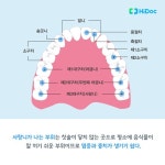 사랑니, 꼭 뽑아야 하나요?