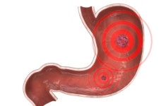 속 쓰린 위염 증상, 오래되면 위암 될까? 궁금증 5