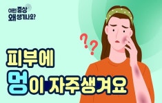 피부에 멍이 자주 생겨요...멍의 원인과 증상은?
