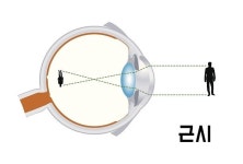 근시와 난시 둘 다 있을 땐...안경? 렌즈? 라식? [눈+사람]
