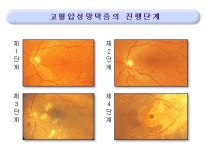 눈속 혈관도 파괴하는 고혈압...고혈압 망막병증 막으려면? [눈+사람]