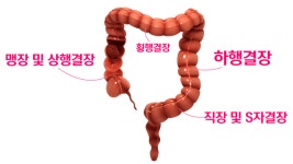 대장암, 위치따라 증상 다르다… 변비는 왼쪽, 빈혈은 오른쪽