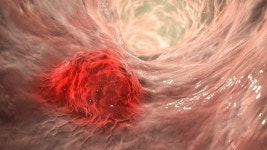 대장암 전단계 선종…추적 내시경 필요한 고위험군은?