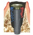 바이오템, 신개념 임플란트 스크류 바이오아크 출시