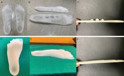 국제성모병원 심동우 교수, 족저근막염 환자 전용 안창 개발