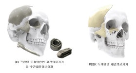 [K-HOSPITAL FAIR] 커스메디, 3D 프린팅 환자맞춤형 의료기기 출품