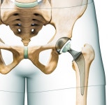 인공 고관절 재수술 원인, 수술 후 경과 시기 따라 달라