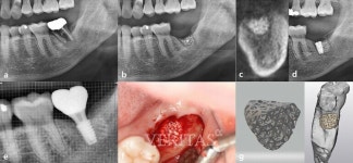한림대 임상치의학대학원 연구진 임상연구 SCIE 논문 게재 승인