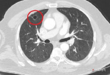 코로나19, 가짜 폐암 종양 만든다…터키서 첫 사례 발견