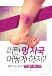 [카드뉴스] 퍼런 멍 자국 어떻게 하지? 멍이 드는 이유? “멍 빨리 빼는 법”