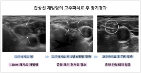 갑상선암 재발에 고주파치료…5년 지나도 재발ㆍ부작용 ↓