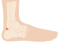 알 수 없는 허리·골반·다리 통증, 이상근 증후군 의심