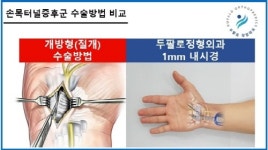 손목터널증후군, 수부내시경 유리술로 입원·통증 부담 완화