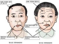 “자고 일어났더니 얼굴이 안 움직여요”…안면신경마비 대처법