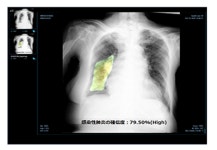 제이엘케이 AI 폐질환 솔루션 日 PMDA 긴급 승인