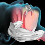 메디슬립, 코골이·수면무호흡증 의료기기 비급여 처방 등재