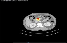 엠에스병원, AI 기반 3D 재건 프로그램 ‘MEDIP PRO’ 도입