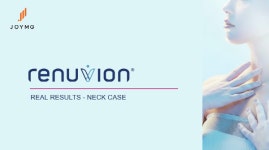 조이엠지, 헬륨 플라즈마 의료기기 ‘리뉴비온’ 국내 의료기기 획득