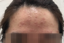 회원청구_9개월_1.6_위더스메디 | 썬크림 부작용 치료비 110만 원, 비급여라 보상 불가?