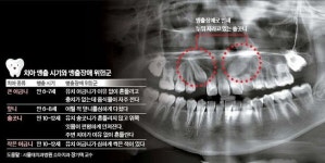  유치 미리 뽑으면 영구치 비뚤어져 부정교합 생긴다 