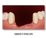  임플란트 실패와 재수술 피하려면 단기간 치료는 안 돼 