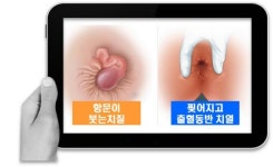  항문출혈, 항문통증 치질로 오해, 만성치열로 진행 