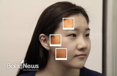 여드름 치료, 해야 하나 말아야 하나